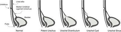 Current management strategies of urachal anomalies in pediatric patients: A scoping review